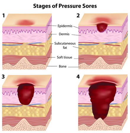 pressure sore